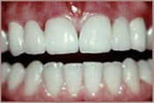 Crowns and Bridges After Brian B. Dolive & Acres Dentistry dentist in Longview, TX Dr. Bian B. Dolive Dr. Acres