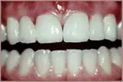 Crowns and Bridges After Brian B. Dolive & Acres Dentistry dentist in Longview, TX Dr. Bian B. Dolive Dr. Acres