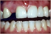 Crowns and Bridges Before Brian B. Dolive & Acres Dentistry dentist in Longview, TX Dr. Bian B. Dolive Dr. Acres