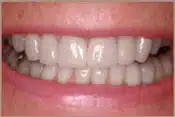 After Crowns and Bridges Brian B. Dolive & Acres Dentistry dentist in Longview, TX Dr. Bian B. Dolive Dr. Acres