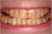 Before Crowns and Bridges Brian B. Dolive & Acres Dentistry dentist in Longview, TX Dr. Bian B. Dolive Dr. Acres