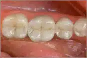 Fillings After Brian B. Dolive & Acres Dentistry dentist in Longview, TX Dr. Bian B. Dolive Dr. Acres