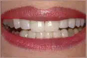 After Veneers Brian B. Dolive & Acres Dentistry dentist in Longview, TX Dr. Bian B. Dolive Dr. Acres