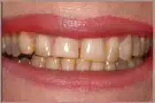 Before Veneers Brian B. Dolive & Acres Dentistry dentist in Longview, TX Dr. Bian B. Dolive Dr. Acres